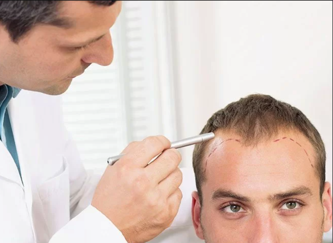 کاشت مو به روش اف آی تی چیست؟